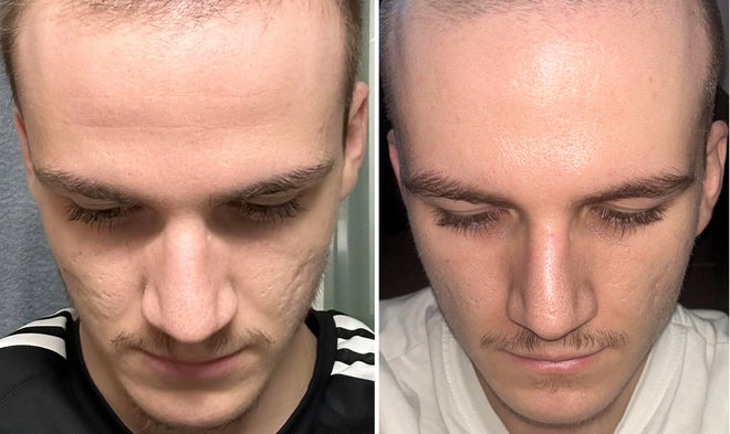 Ráncok és hegek láthatósága