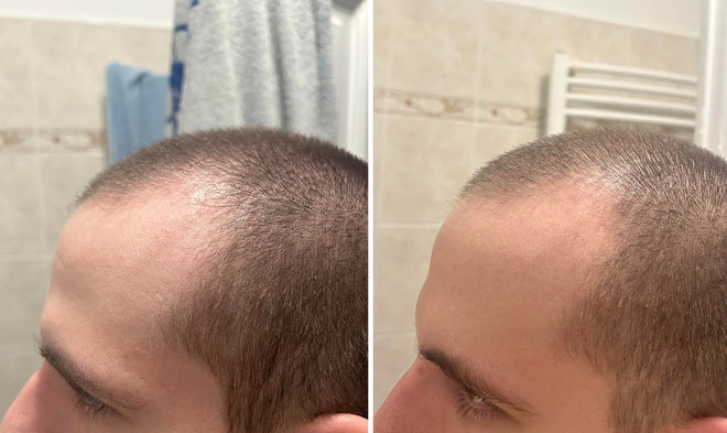 Hajhagymák stimulálása a halántékon