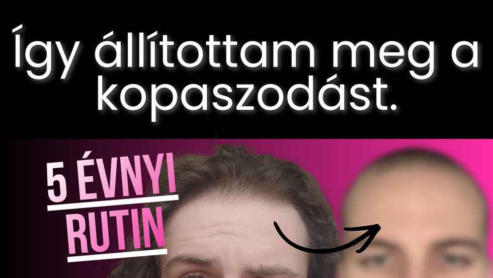 Hogyan állítottam meg a hajhullásom férfiként