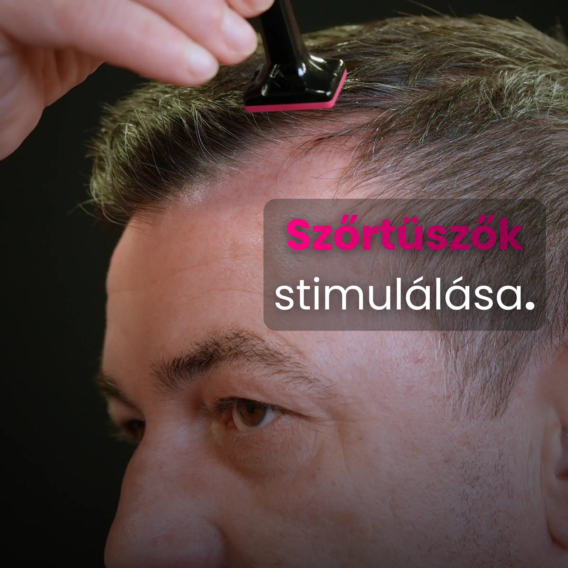 Szőrtüszők stimulálása