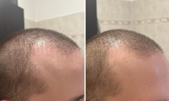 Hajhagymák stimulálása a halántékon